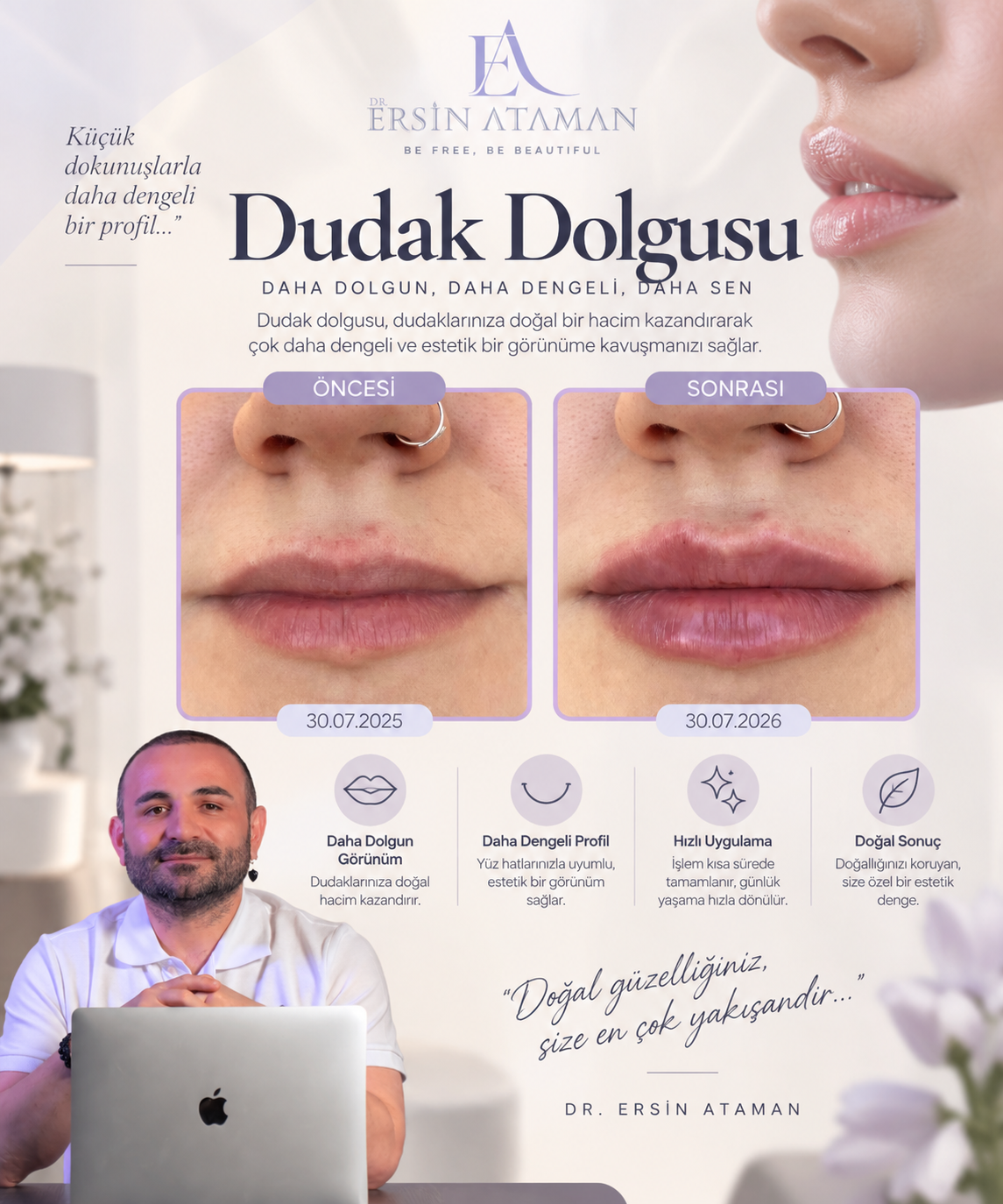 Dr. Ersin Ataman dudak dolgusu öncesi ve sonrası doğal sonuç görseli